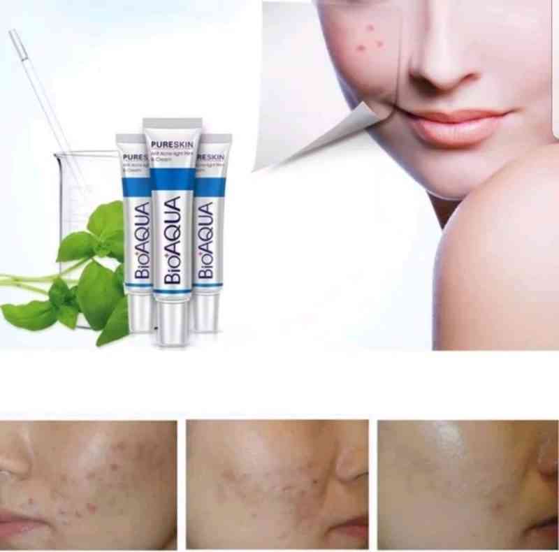 bioaqua pure skin acne treatment cream